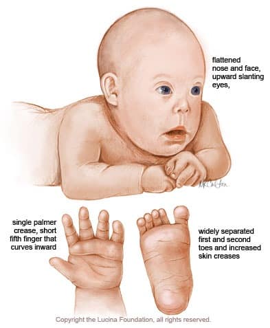 Photo Scanner: Down Syndrome Symptoms