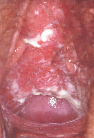 herpes genital photo. VAGINAL CANDIDIASIS (“THRUSH”