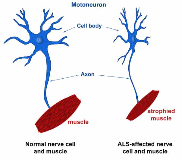 2018 Demystifying Medicine: Amyotrophic Lateral Sclerosis (Lou