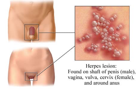 herpes std