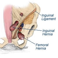 femoral-hernia-picture-new