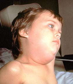 Mumps: Causes & Symptoms