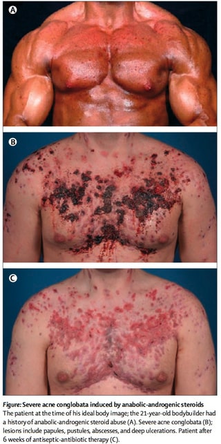 corticosteroids side effects