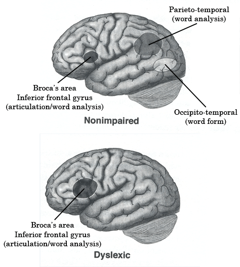 dyslexia-causes-symptoms-treatment-schoolworkhelper