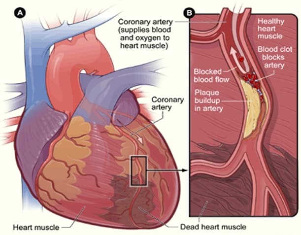 Is Ischemic Heart Disease Chronic