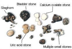 types of kidney stones